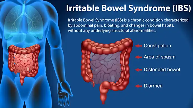Irritable bowel syndrome - Image 3
